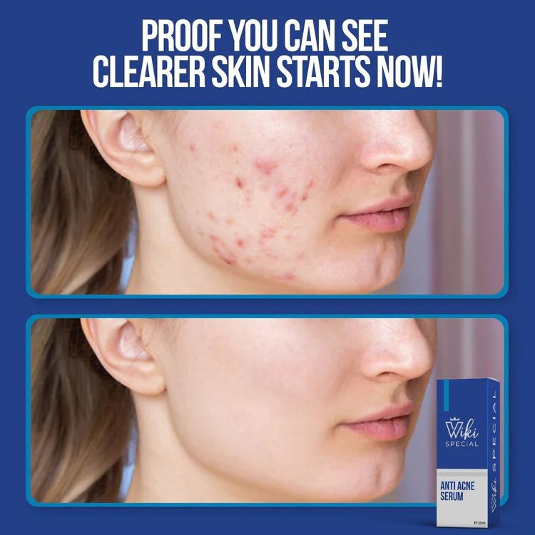 Wiki Special Acne Serum
